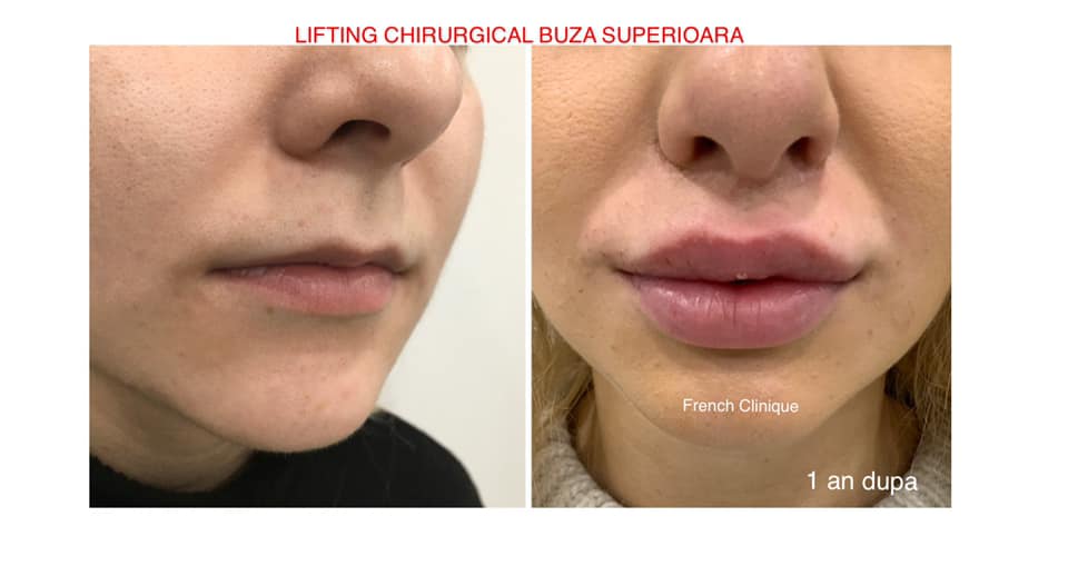 Lifting de buze by French Clinique