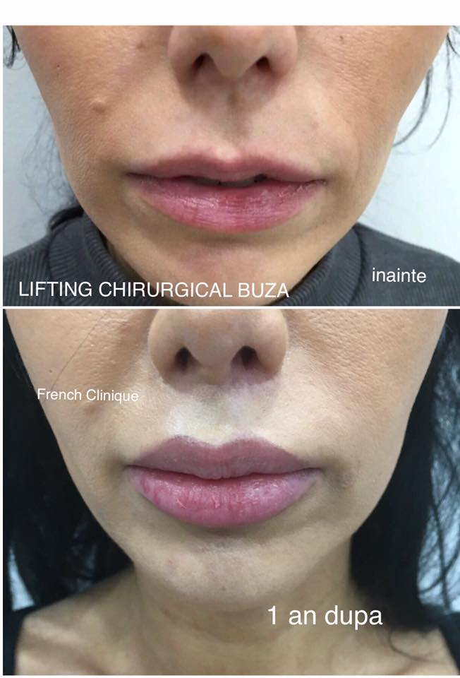 Lifting de buze by French Clinique