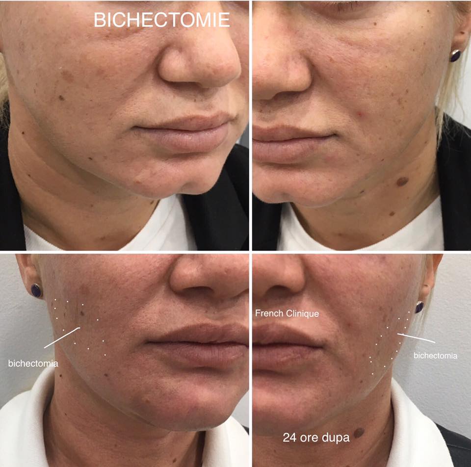 Bichectomie by French Clinique