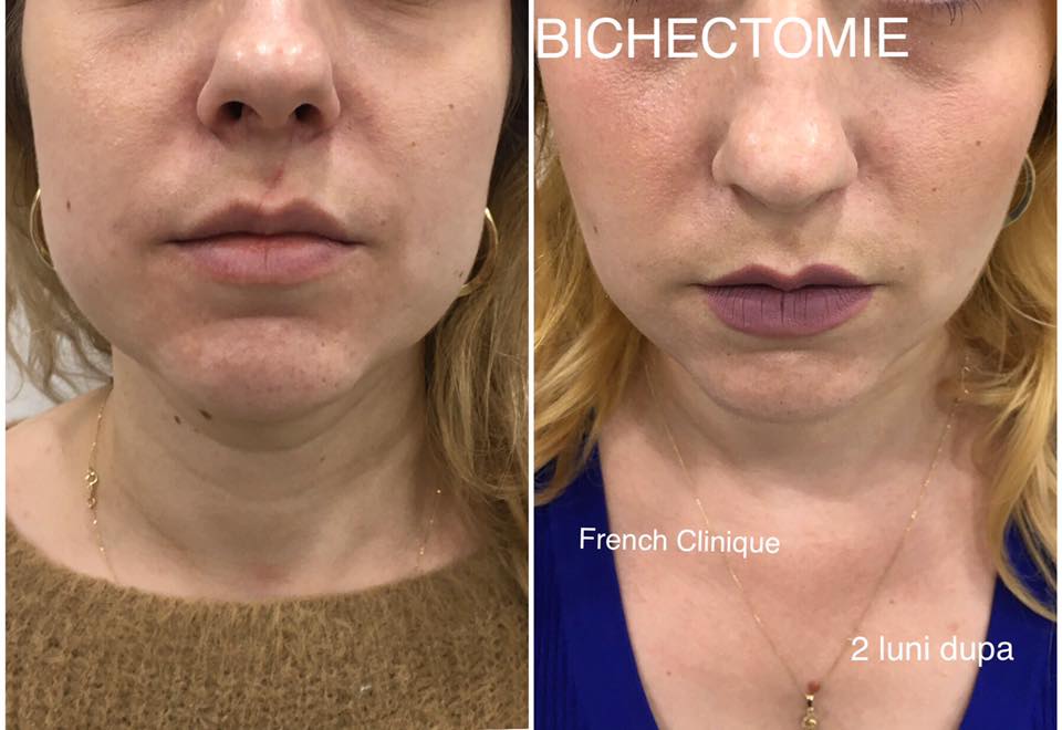Bichectomie by French Clinique