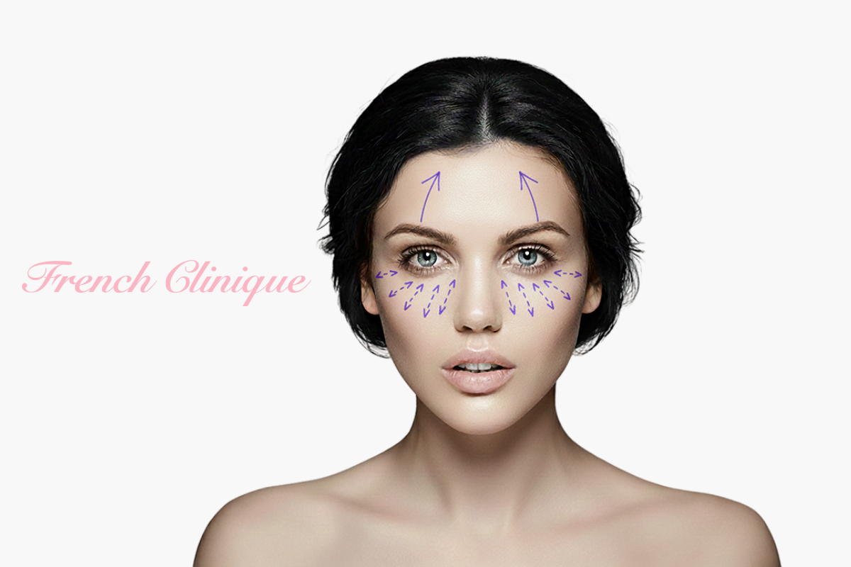 Blefaroplastia superioara