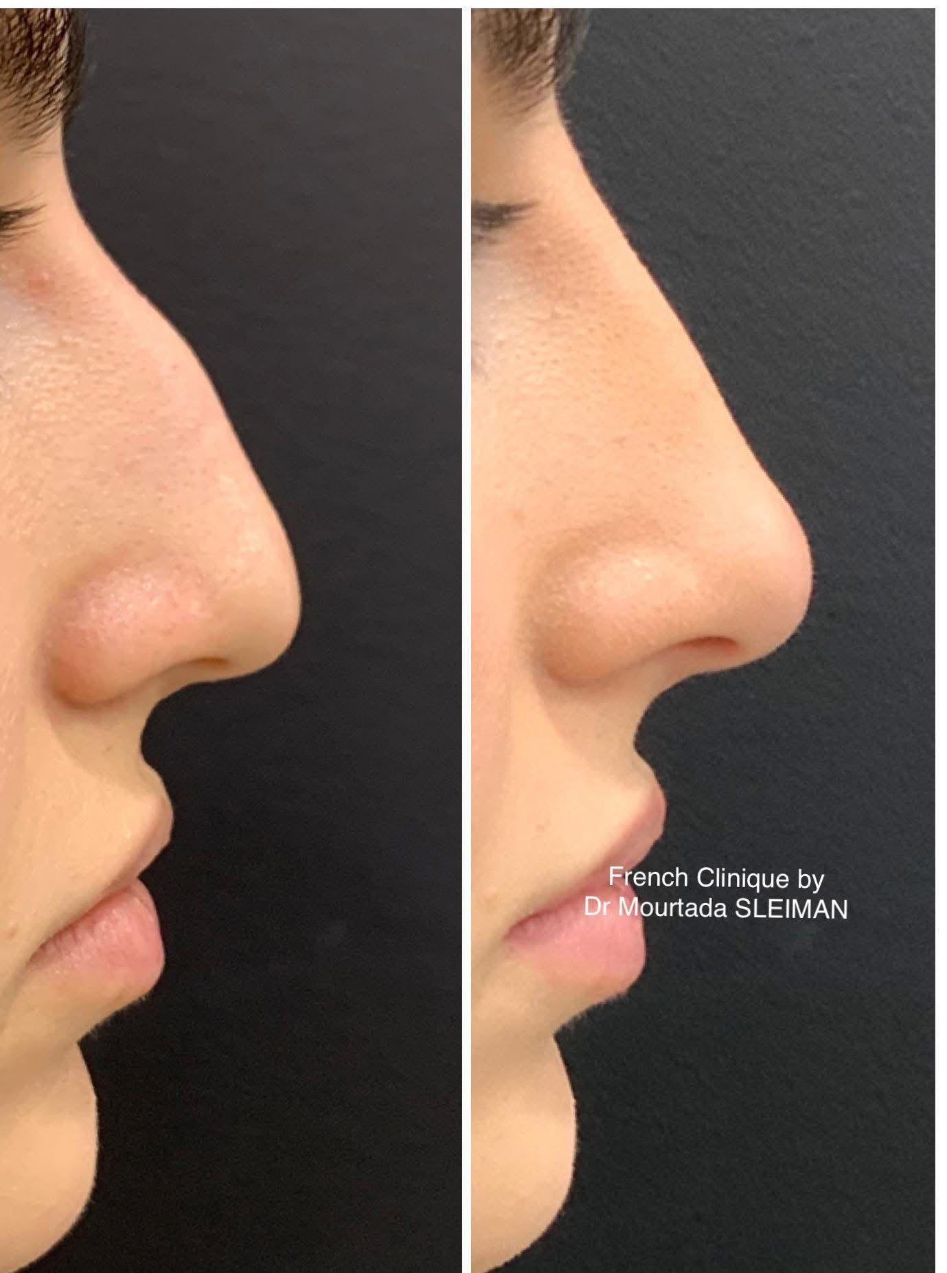 Rinocorectie by French Clinique