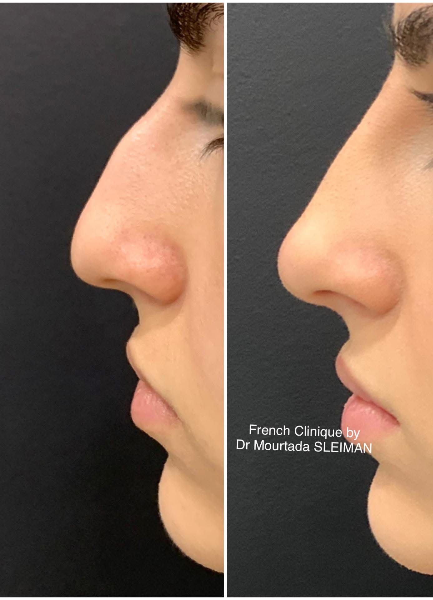 Rinocorectie by French Clinique
