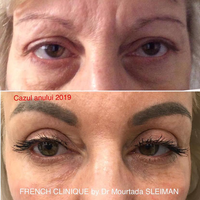Blefaroplastie inferioara